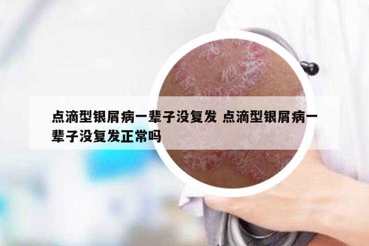 点滴型银屑病一辈子没复发 点滴型银屑病一辈子没复发正常吗