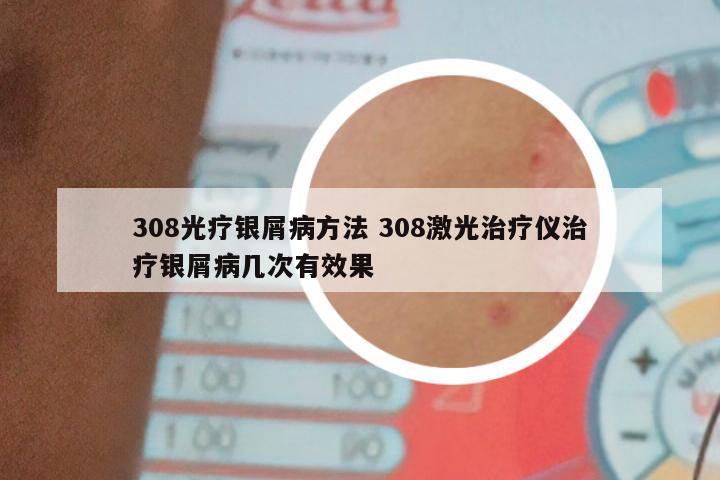 308光疗银屑病方法 308激光治疗仪治疗银屑病几次有效果