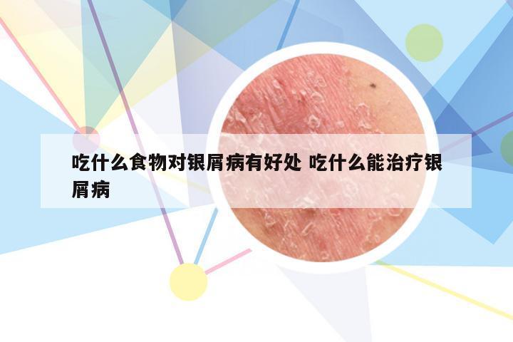 吃什么食物对银屑病有好处 吃什么能治疗银屑病