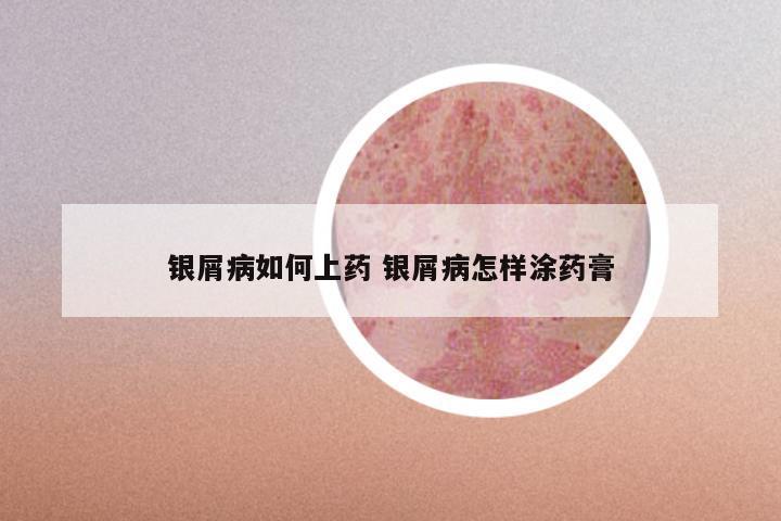 银屑病如何上药 银屑病怎样涂药膏