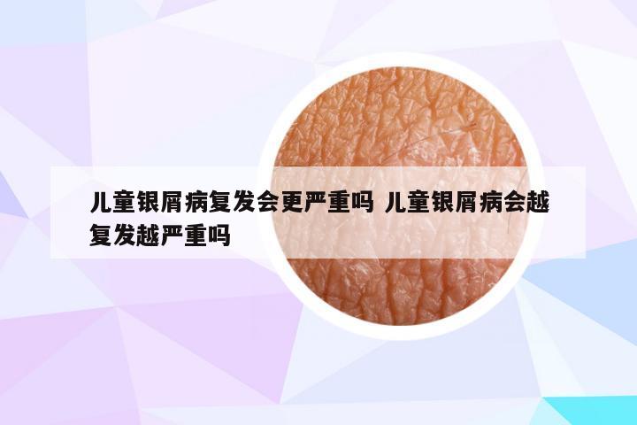 儿童银屑病复发会更严重吗 儿童银屑病会越复发越严重吗