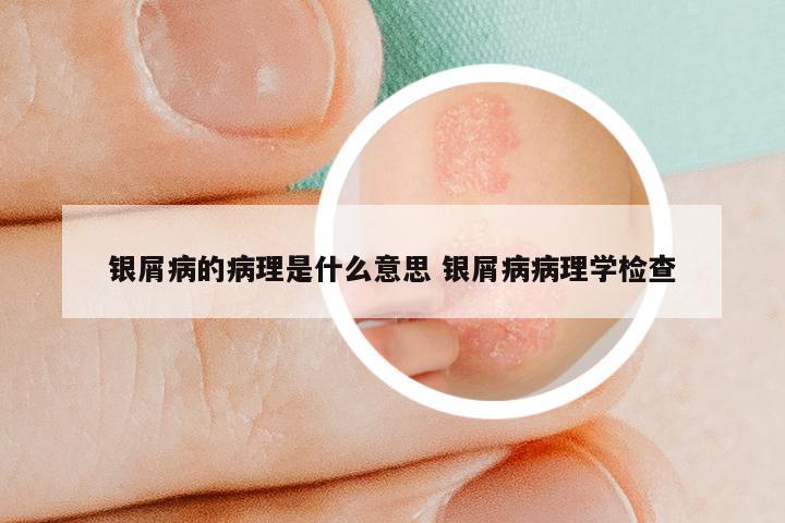 银屑病的病理是什么意思 银屑病病理学检查