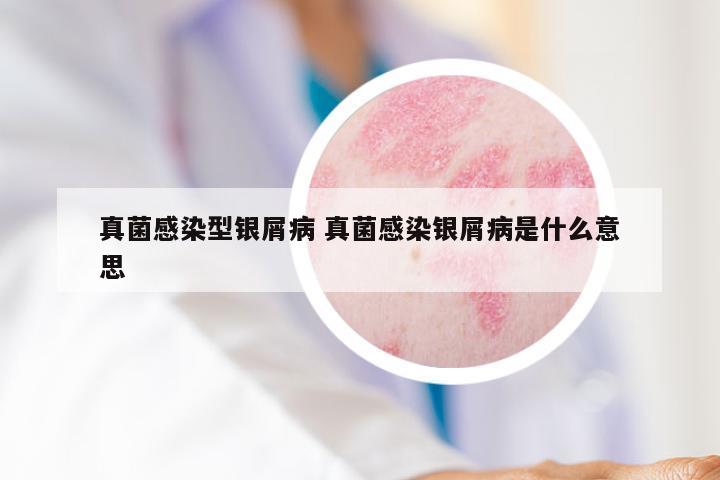 真菌感染型银屑病 真菌感染银屑病是什么意思