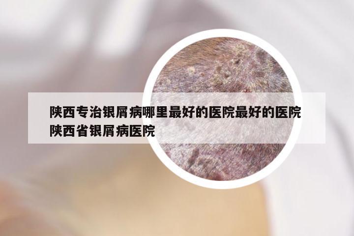 陕西专治银屑病哪里最好的医院最好的医院 陕西省银屑病医院