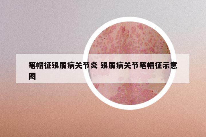 笔帽征银屑病关节炎 银屑病关节笔帽征示意图