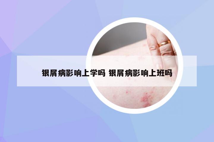 银屑病影响上学吗 银屑病影响上班吗