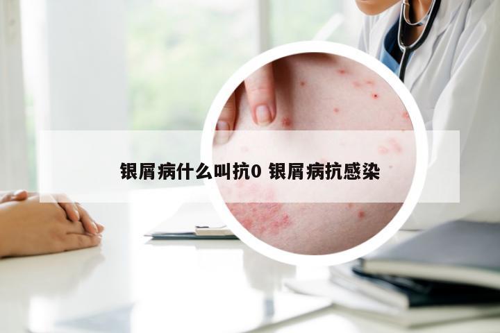 银屑病什么叫抗0 银屑病抗感染