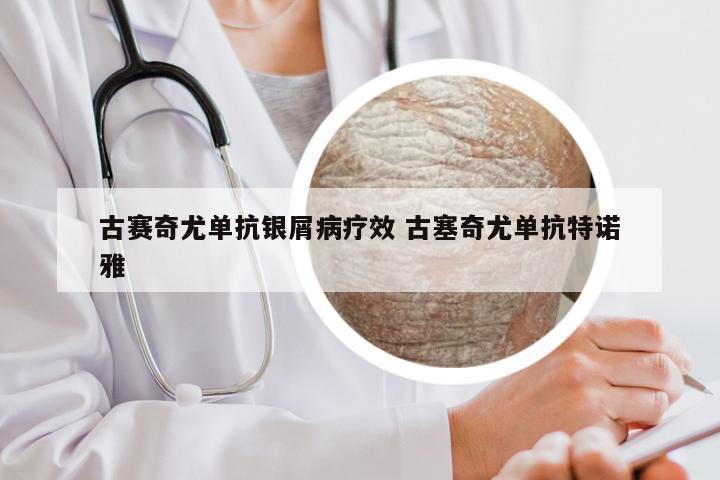 古赛奇尤单抗银屑病疗效 古塞奇尤单抗特诺雅