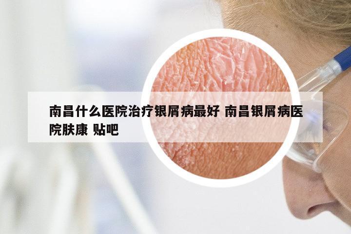 南昌什么医院治疗银屑病最好 南昌银屑病医院肤康 贴吧