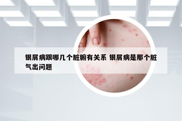 银屑病跟哪几个脏腑有关系 银屑病是那个脏气出问题