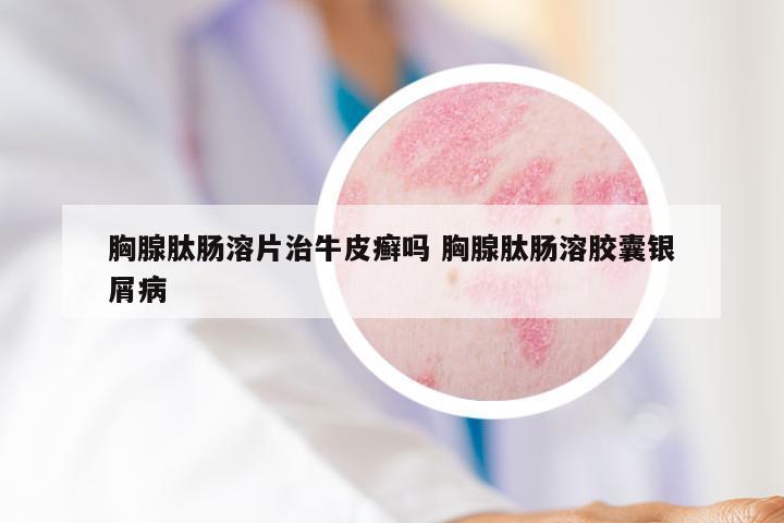 胸腺肽肠溶片治牛皮癣吗 胸腺肽肠溶胶囊银屑病