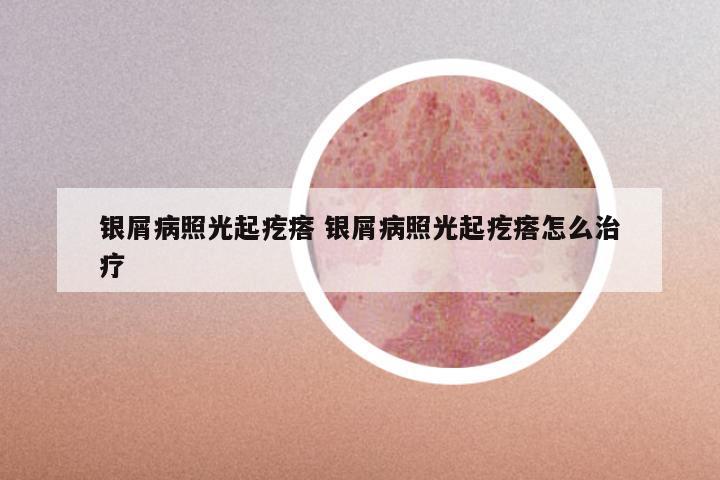 银屑病照光起疙瘩 银屑病照光起疙瘩怎么治疗