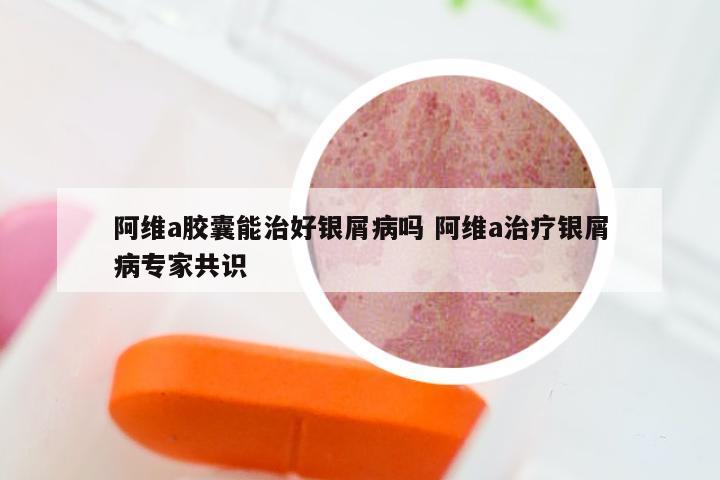 阿维a胶囊能治好银屑病吗 阿维a治疗银屑病专家共识