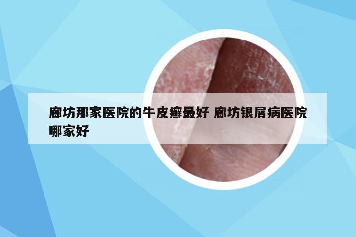 廊坊那家医院的牛皮癣最好 廊坊银屑病医院哪家好