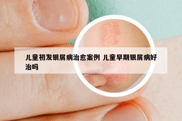 儿童初发银屑病治愈案例 儿童早期银屑病好治吗