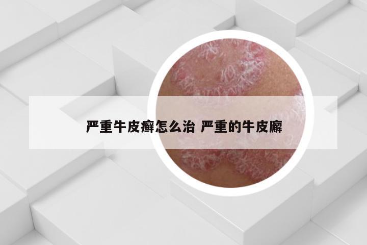 严重牛皮癣怎么治 严重的牛皮廨