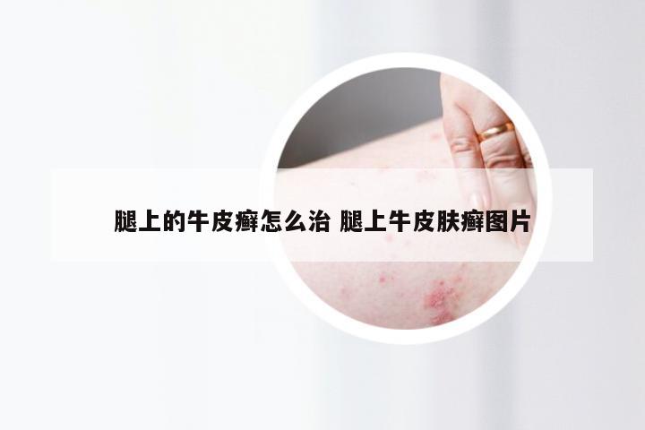 腿上的牛皮癣怎么治 腿上牛皮肤癣图片