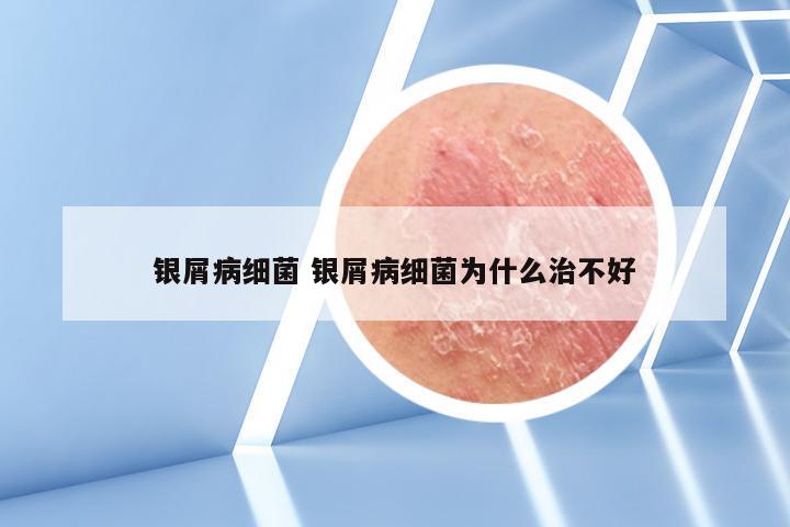 银屑病细菌 银屑病细菌为什么治不好