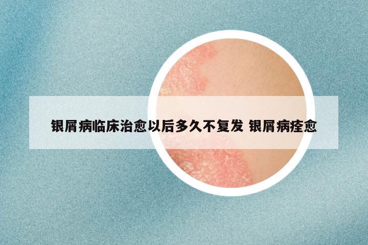 银屑病临床治愈以后多久不复发 银屑病痊愈