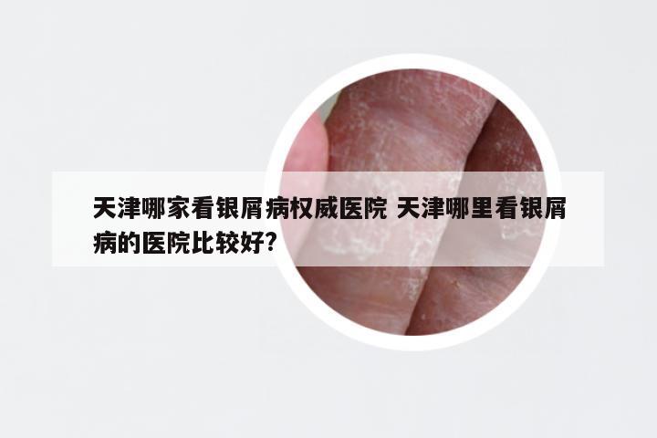 天津哪家看银屑病权威医院 天津哪里看银屑病的医院比较好?