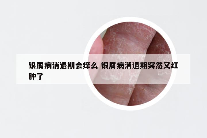 银屑病消退期会痒么 银屑病消退期突然又红肿了