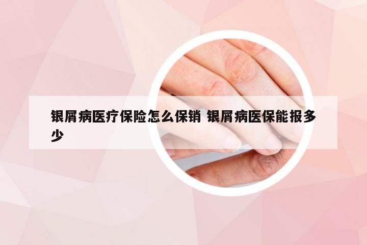 银屑病医疗保险怎么保销 银屑病医保能报多少