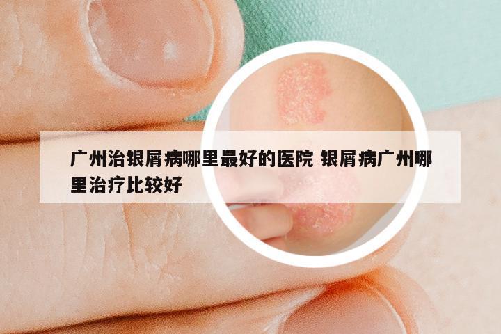 广州治银屑病哪里最好的医院 银屑病广州哪里治疗比较好