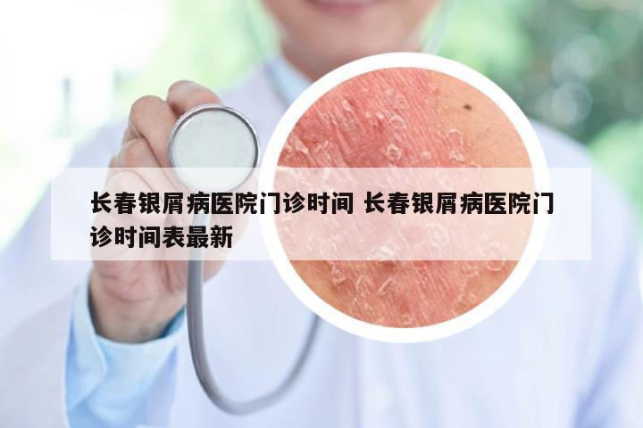 长春银屑病医院门诊时间 长春银屑病医院门诊时间表最新