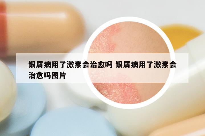 银屑病用了激素会治愈吗 银屑病用了激素会治愈吗图片