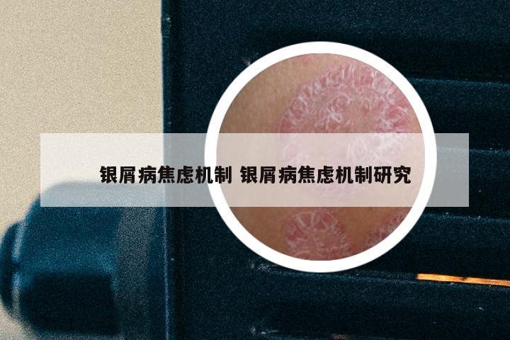 银屑病焦虑机制 银屑病焦虑机制研究