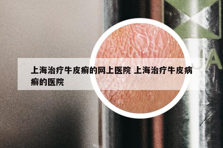 上海治疗牛皮癣的网上医院 上海治疗牛皮病癣的医院