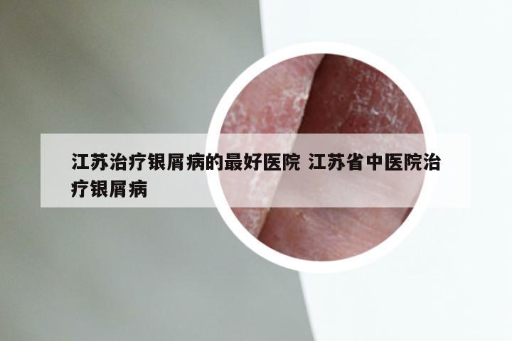 江苏治疗银屑病的最好医院 江苏省中医院治疗银屑病