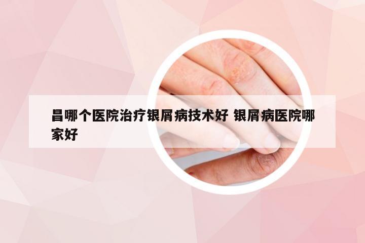 昌哪个医院治疗银屑病技术好 银屑病医院哪家好