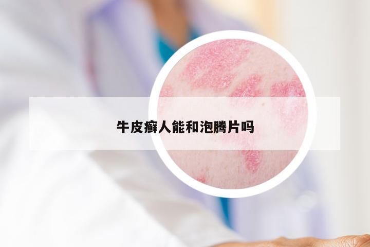 牛皮癣人能和泡腾片吗