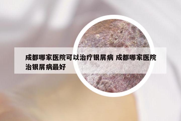 成都哪家医院可以治疗银屑病 成都哪家医院治银屑病最好