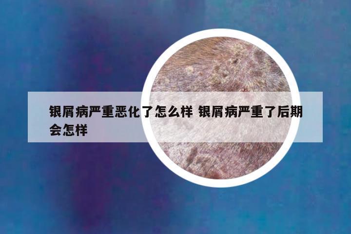 银屑病严重恶化了怎么样 银屑病严重了后期会怎样