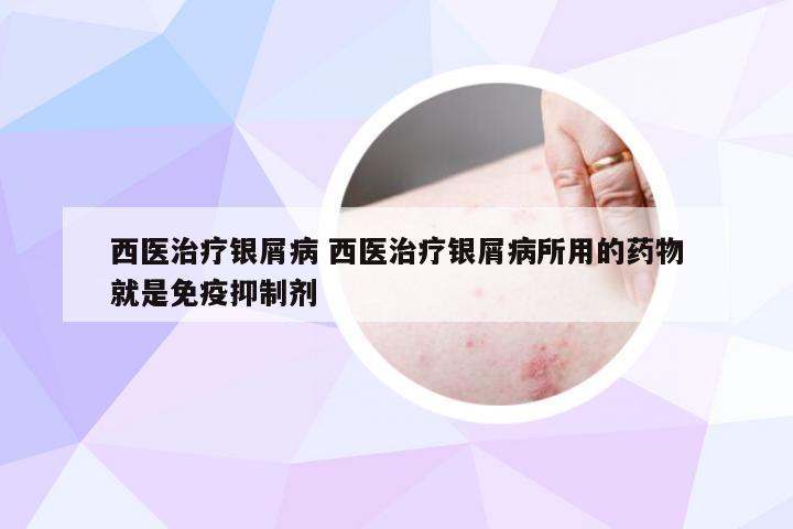 西医治疗银屑病 西医治疗银屑病所用的药物就是免疫抑制剂