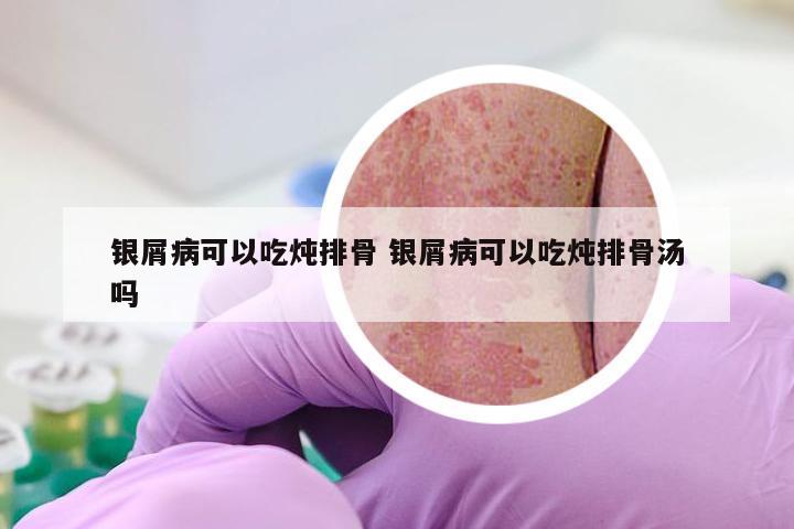 银屑病可以吃炖排骨 银屑病可以吃炖排骨汤吗