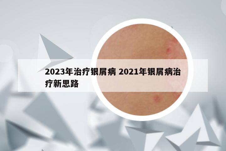 2023年治疗银屑病 2021年银屑病治疗新思路