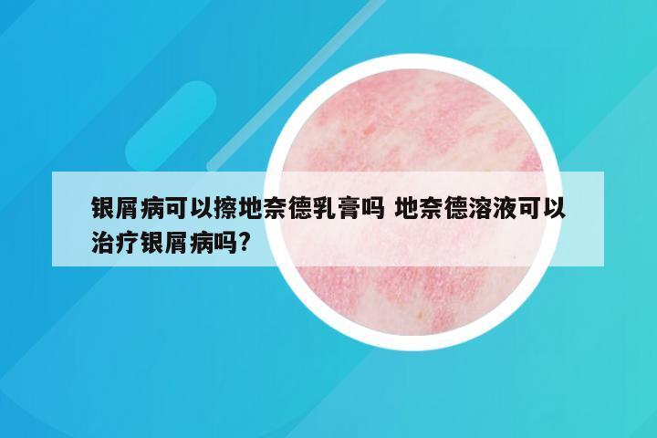 银屑病可以擦地奈德乳膏吗 地奈德溶液可以治疗银屑病吗?