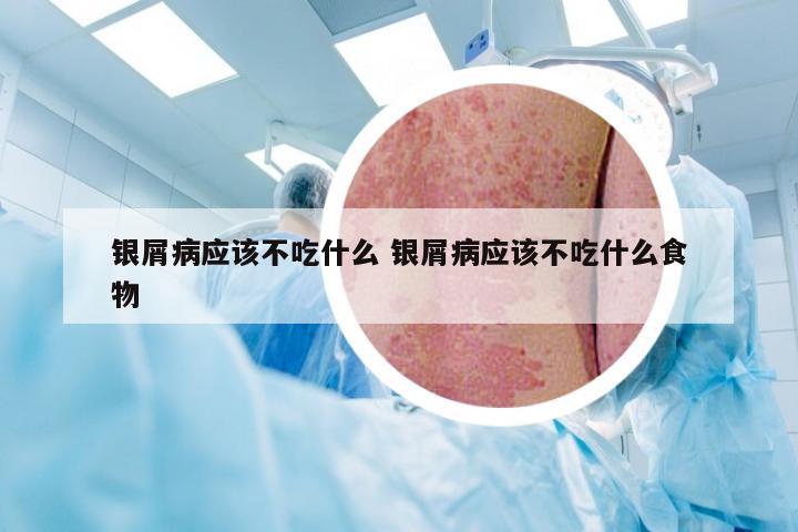 银屑病应该不吃什么 银屑病应该不吃什么食物