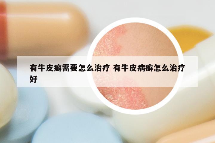 有牛皮癣需要怎么治疗 有牛皮病癣怎么治疗好