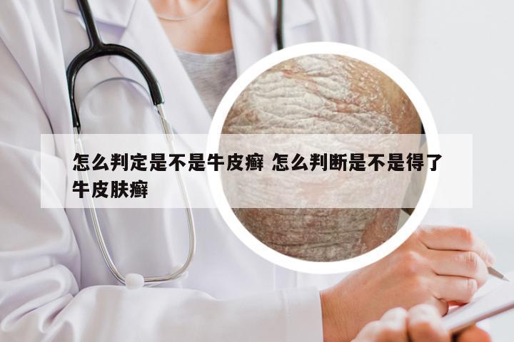 怎么判定是不是牛皮癣 怎么判断是不是得了牛皮肤癣