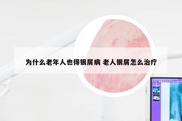 为什么老年人也得银屑病 老人银屑怎么治疗