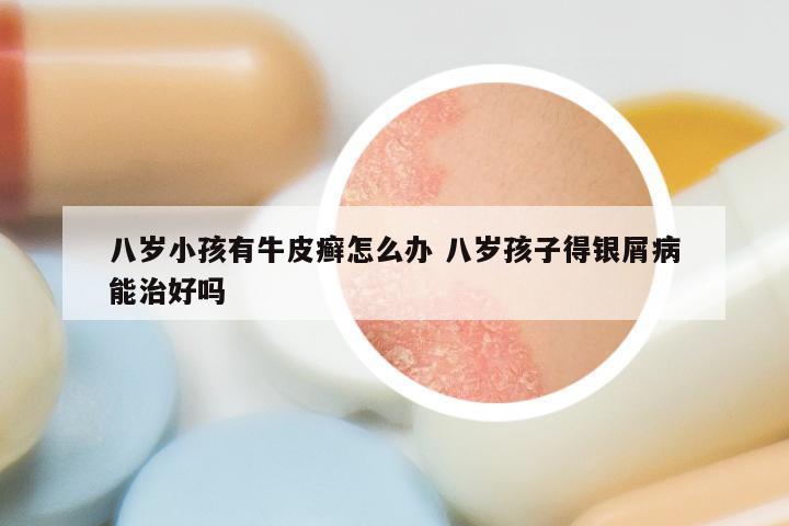 八岁小孩有牛皮癣怎么办 八岁孩子得银屑病能治好吗