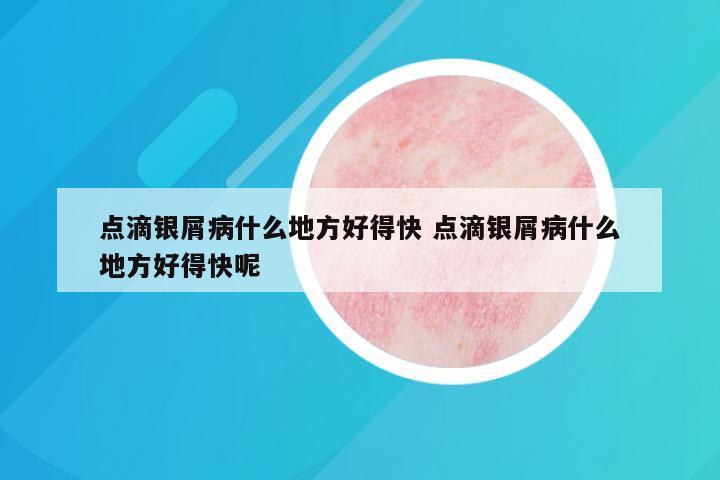 点滴银屑病什么地方好得快 点滴银屑病什么地方好得快呢