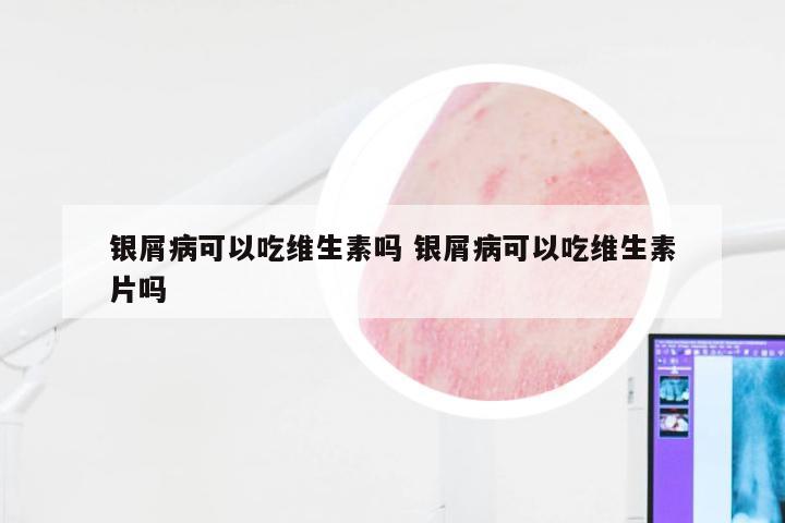 银屑病可以吃维生素吗 银屑病可以吃维生素片吗