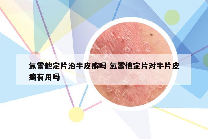 氯雷他定片治牛皮癣吗 氯雷他定片对牛片皮癣有用吗