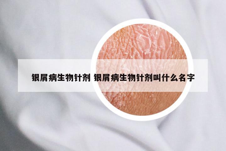 银屑病生物针剂 银屑病生物针剂叫什么名字