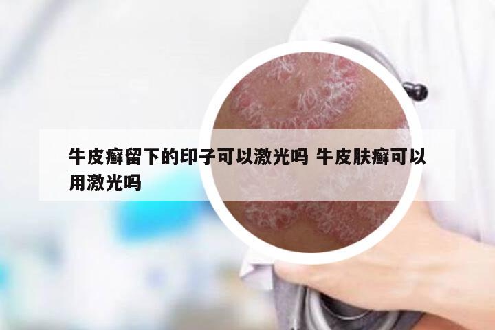 牛皮癣留下的印子可以激光吗 牛皮肤癣可以用激光吗